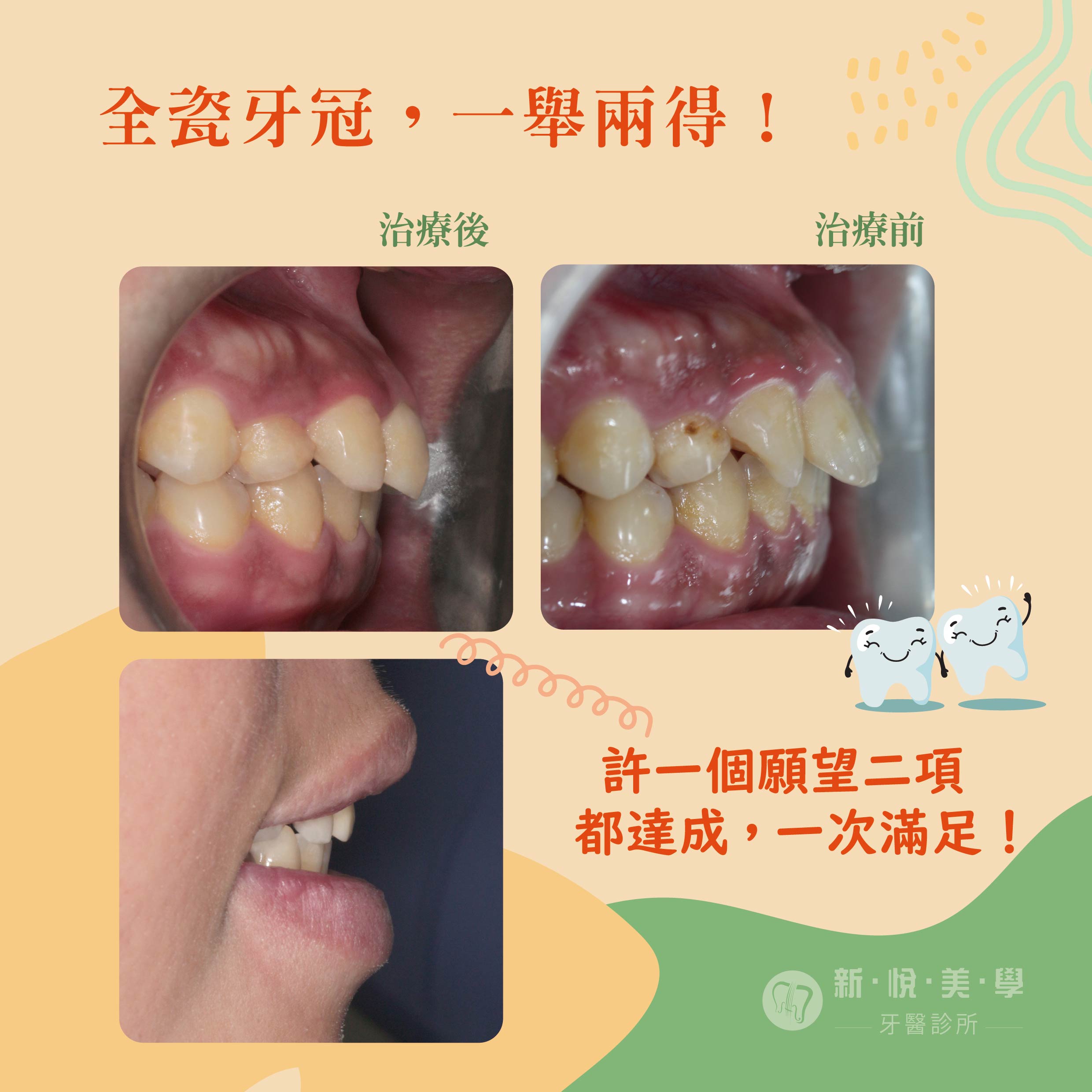   蝦米！暴牙不用矯正的第2張圖片